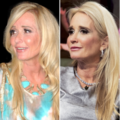 Kim Richard's of the Real House Wives of Beverly Hills, Before & After Rhinoplasty